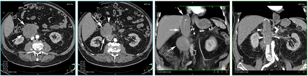 Primary tumor of the IVC